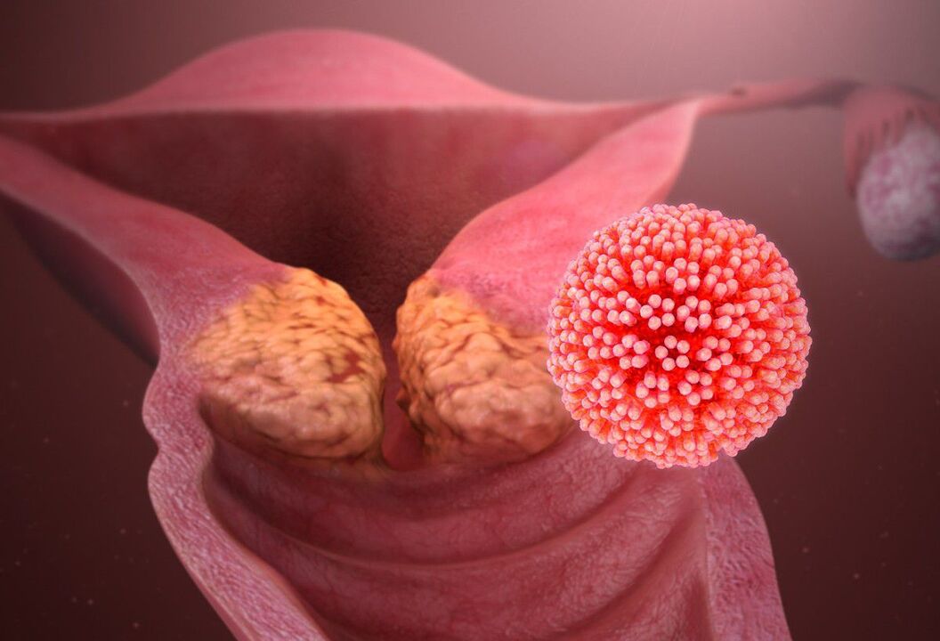 HPV lezija cerviksa