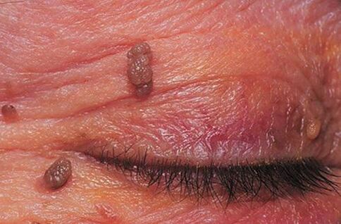 Papilomi na koži kapaka koji zahtijevaju liječenje