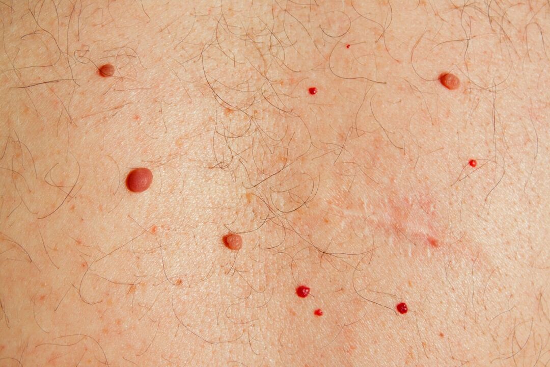 Papilomi na tijelu uzrokovani HPV-om