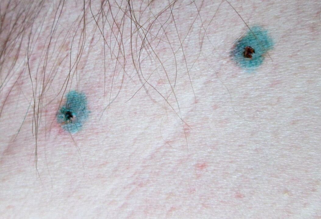 Tragovi na koži nakon laserskog uklanjanja papiloma